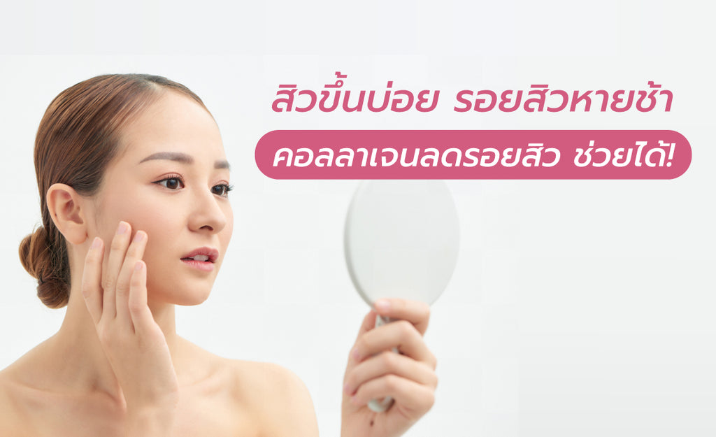 สิวขึ้นบ่อย รอยสิวหายช้า คอลลาเจนลดรอยสิว ช่วยได้!